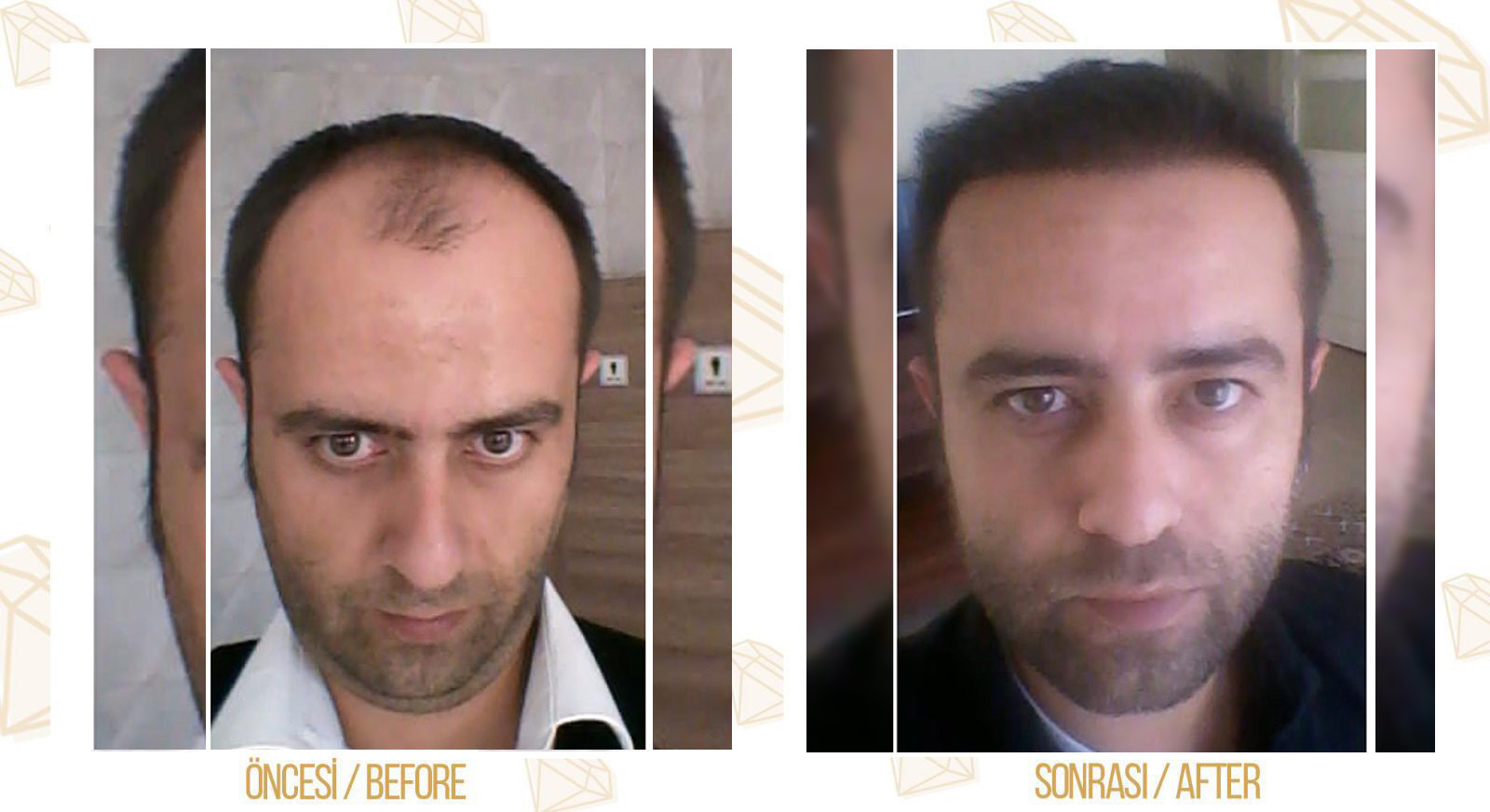 Fue Hair Transplantation - Diamonds Clinic Aesthetic and ...